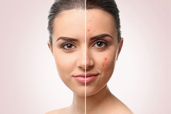 Как избавиться от постакне? Как избавиться от постакне?